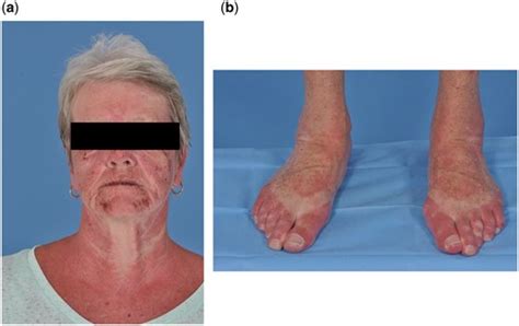 Doxycycline and photosensitivity