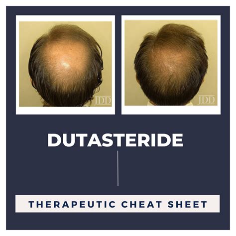 Dutasteride Comparison