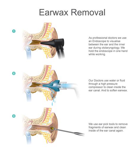Ear wax removal conclusion