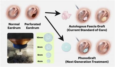 Eardrum Healing Process