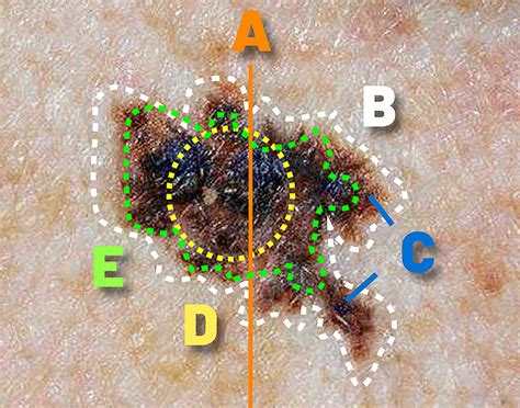 Early Detection and Treatment of Melanoma