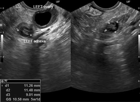 Ectopic Pregnancy and Relationships