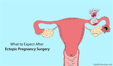 ectopic pregnancy surgery risks