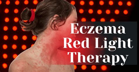 Effectiveness of Eczema Light Therapy