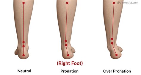 Effects of Abnormal Foot Pronation