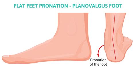 Effects of Pronation Foot