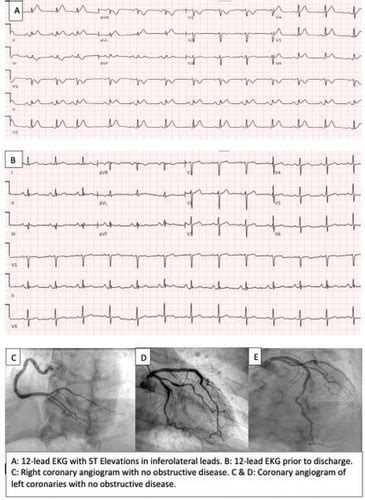 Ekg conclusion