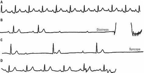 Limitations of EKG