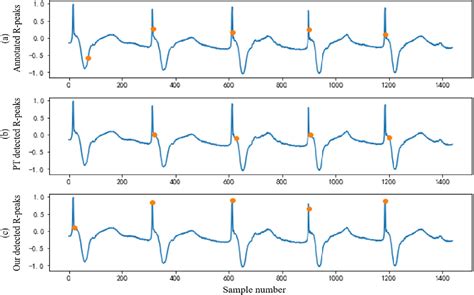 electrocardiogram