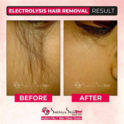 Electrolysis Hair Removal