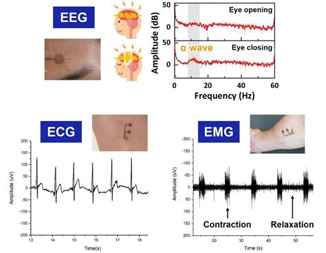 Conditions Diagnosed with EMG