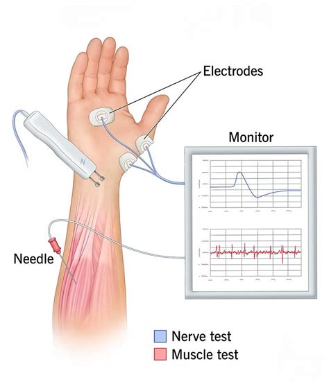 Limitations and Risks of EMG