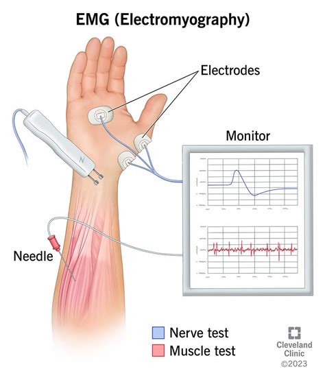Interpreting EMG Results