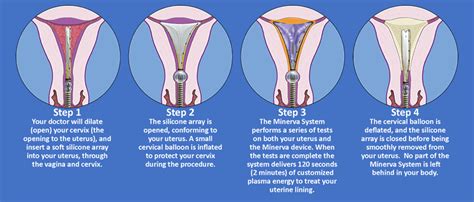 Benefits of Endometrial Ablation