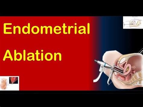 Recovery After Endometrial Ablation