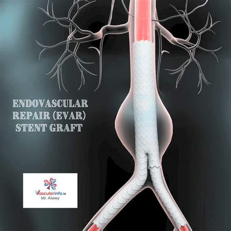 endovascular aneurysm repair working mechanism