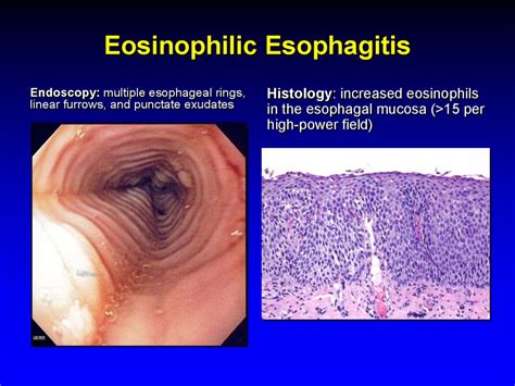 Eosinophilic Esophagitis Overview