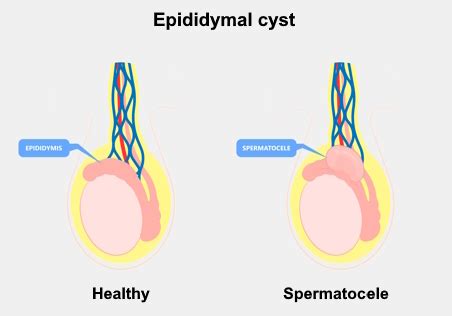 Epididymis cyst overview