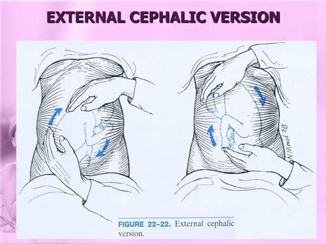 External cephalic version