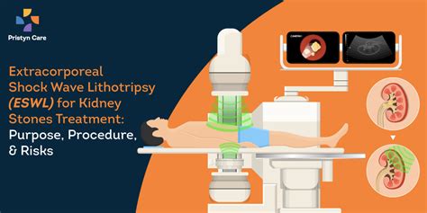 extracorporeal shock wave lithotripsy