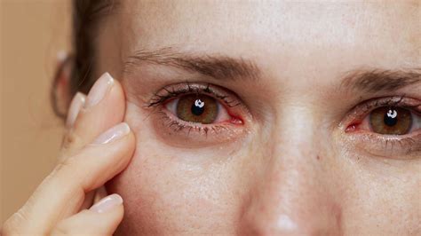 eye inflammation