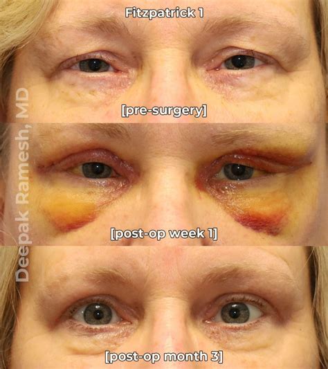 eyelid surgery recovery
