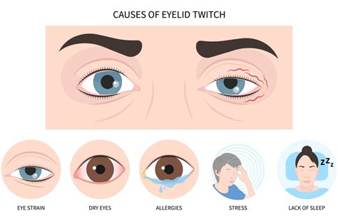 Eyelid Twitching Causes