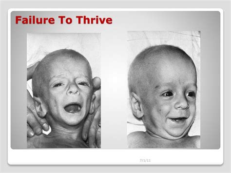 failure to thrive