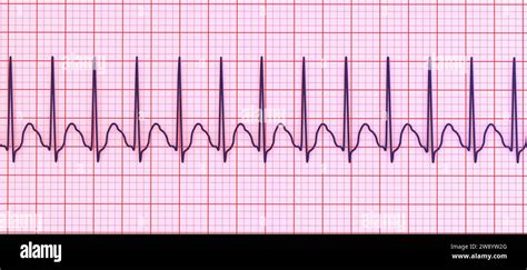 fast heart rate symptoms