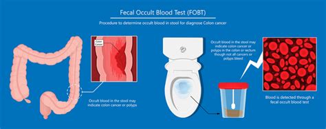 Fecal Occult Blood Test Risks and Side Effects