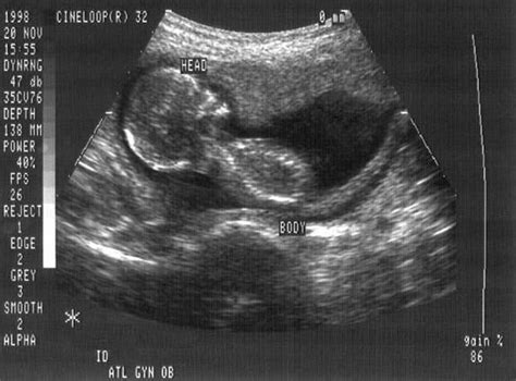 Fetus pictures at 5 weeks