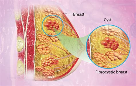 Fibrocystic Breast Condition Causes