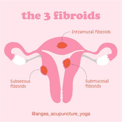 Fibroid types