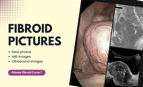 Fibroids Development