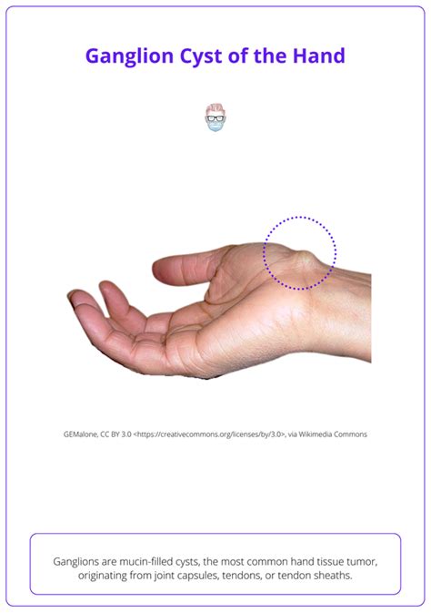 final thoughts on ganglion cysts