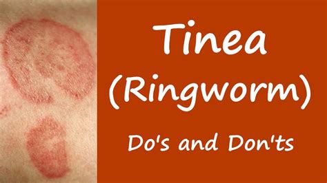 final thoughts on ringworm