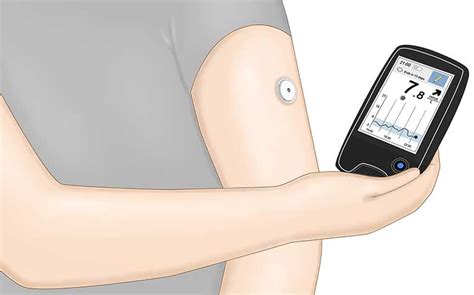 Flash Glucose Monitoring