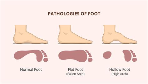 Flat Feet Image