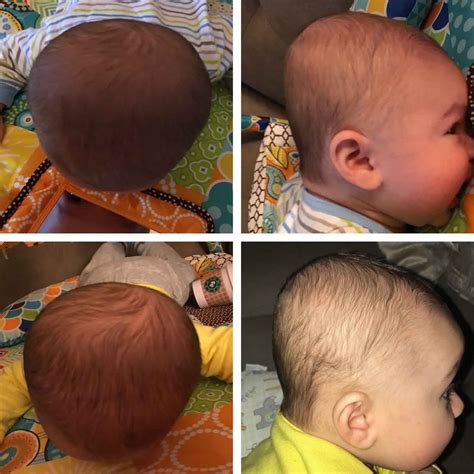 Flat Head Syndrome