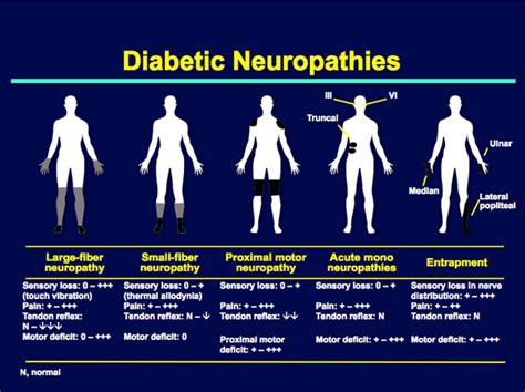 focal neuropathy