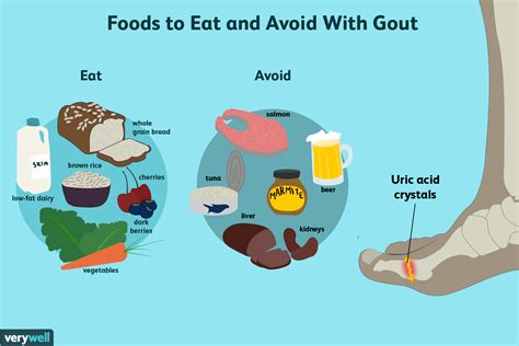 Foods to avoid for gout relief