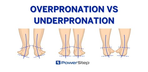 Foot Pronation