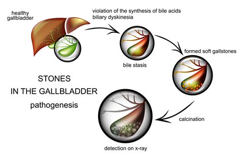 formation of gallstones
