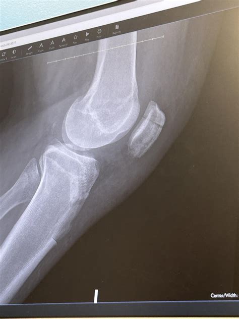 Fractured Knee Cap