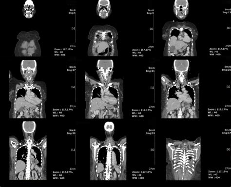 Full Body CT Scan Risks