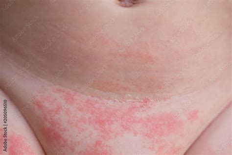 Complications of Fungal Diaper Rash