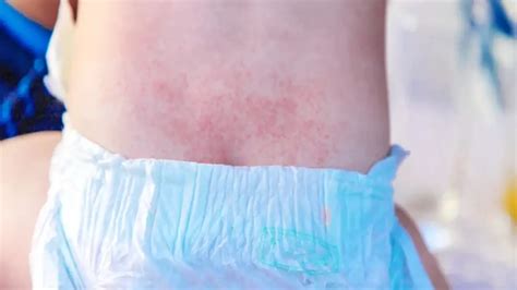 Fungal Diaper Rash Treatment Options