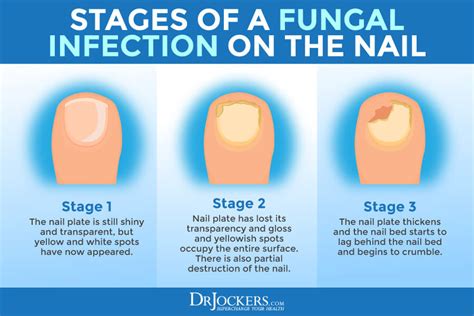 Fungal foot nail infection symptoms