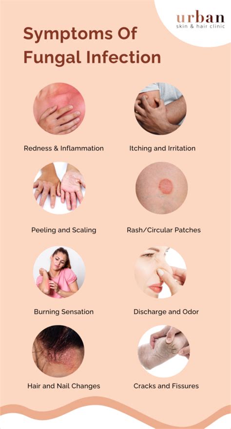 fungal infection causes