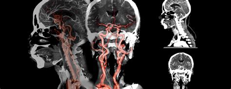 Future developments in CT scan angiography